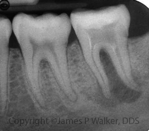 Molar with apical and furcal bone loss